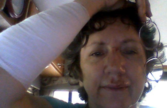 This is what I looked like the day after the accident.